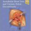 Treatment of Acetabular Bone Loss and Chronic Pelvic Discontinuity