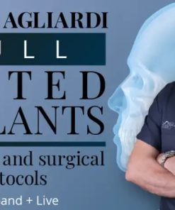 Full tilted implants Prosthetic and Surgical protocols