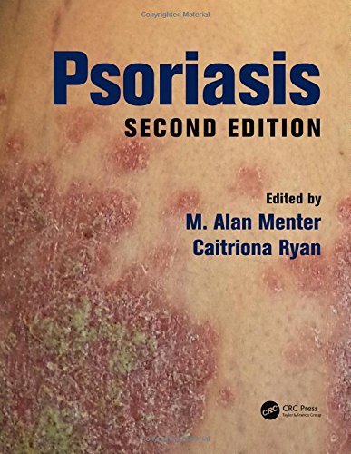 Psoriasis, Second Edition